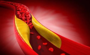 Il colesterolo HDL non è un indicatore universale del rischio d’infarto